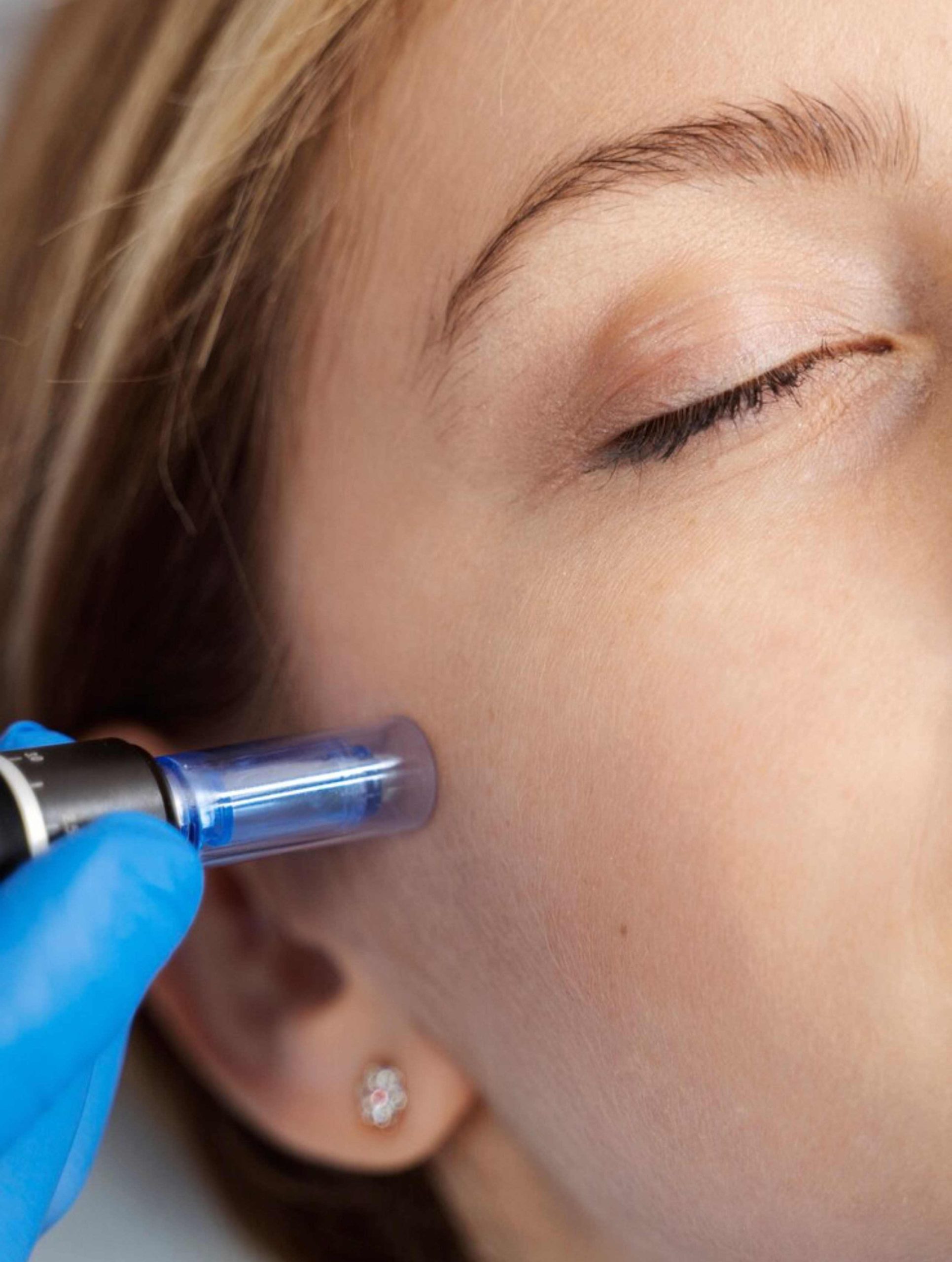 woman-microneedling