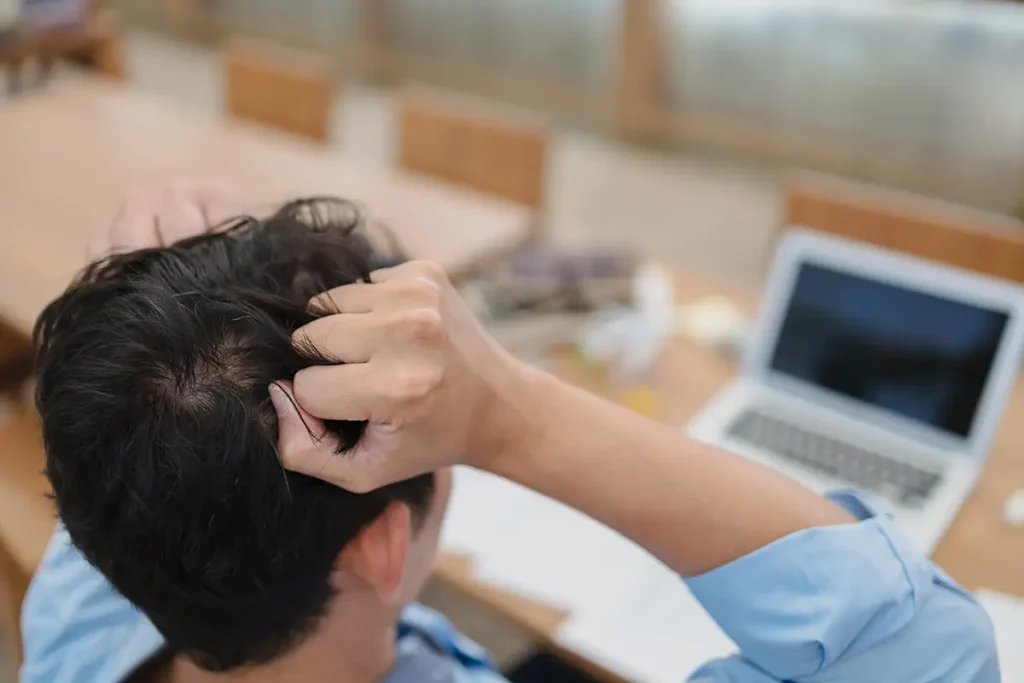 symptoms for alopecia areata